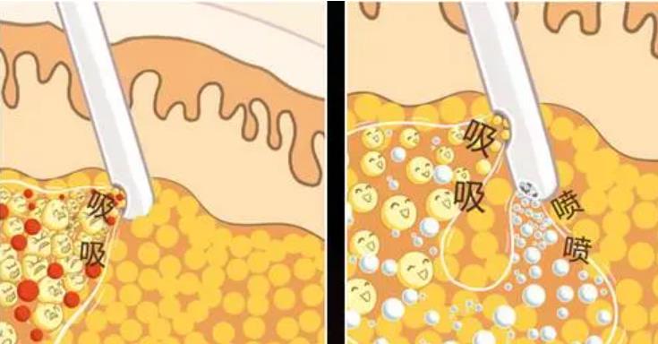抽脂