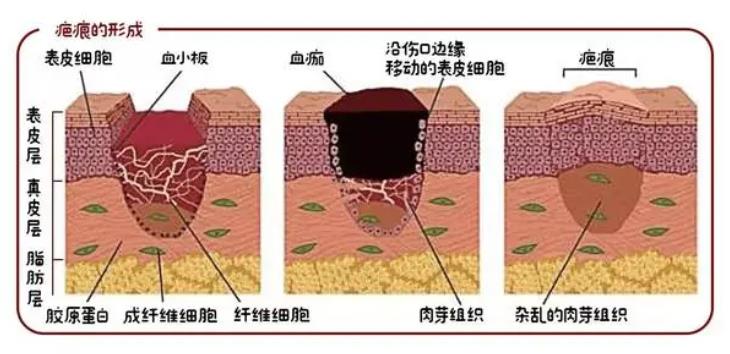 疤痕