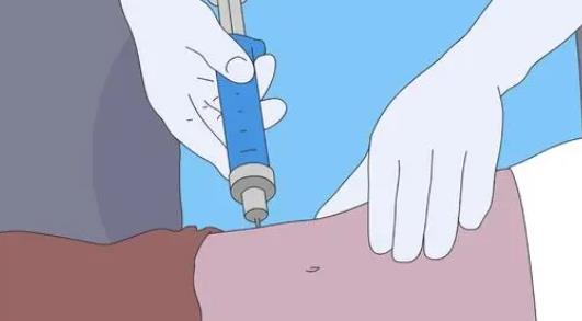 吸脂