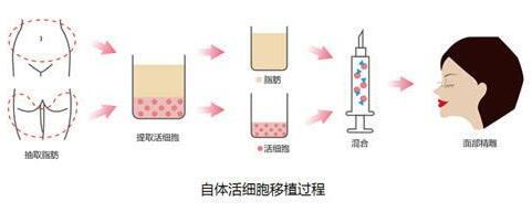 上海伊莱美做脂肪填充案例分享