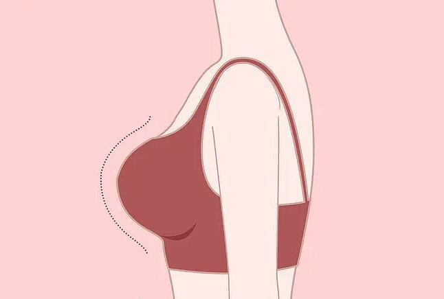 丰胸手术