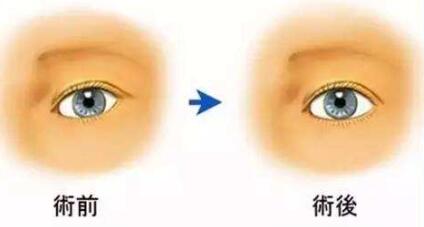 徐扬阳双眼皮案例
