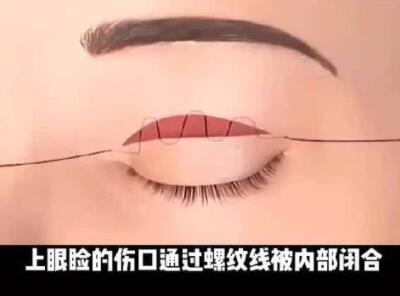 徐州李雪阳医生双眼皮手术案例
