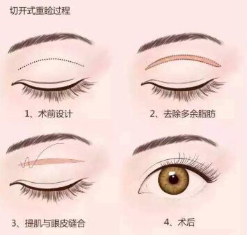 郑大五附院徐扬阳双眼皮手术案例分享
