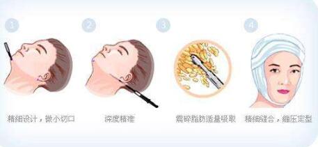 刘李娜医生案例分享