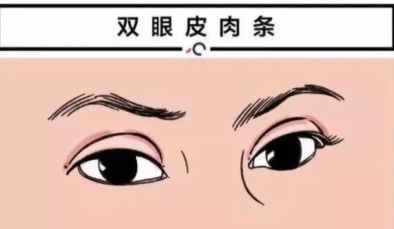 张安利医生双眼皮修复案例分享