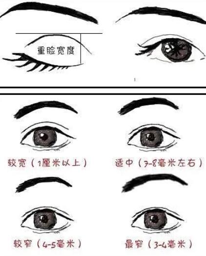 潘贰双眼皮修复案例
