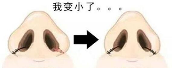张华辉鼻翼缩小案例分享