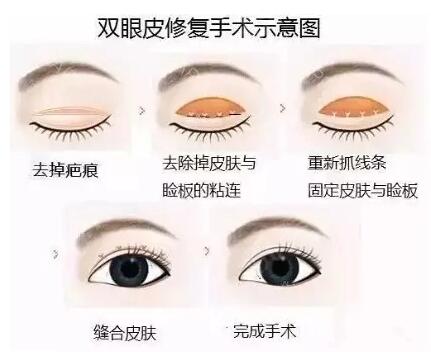 邵玉芳修复双眼皮案例分享