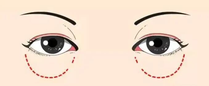 去眼袋
