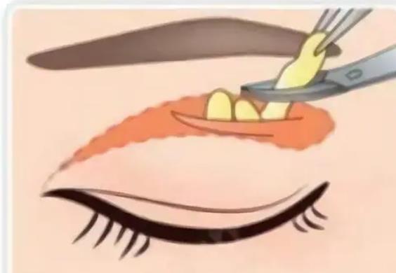 双眼皮
