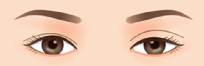 双眼皮