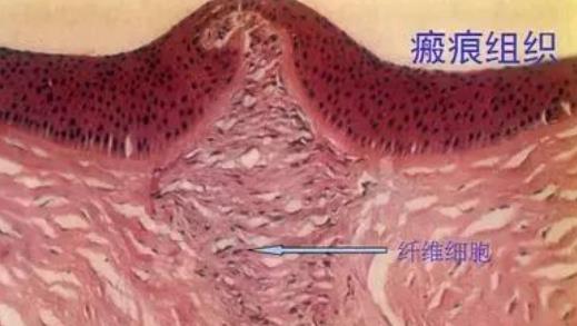 疤痕