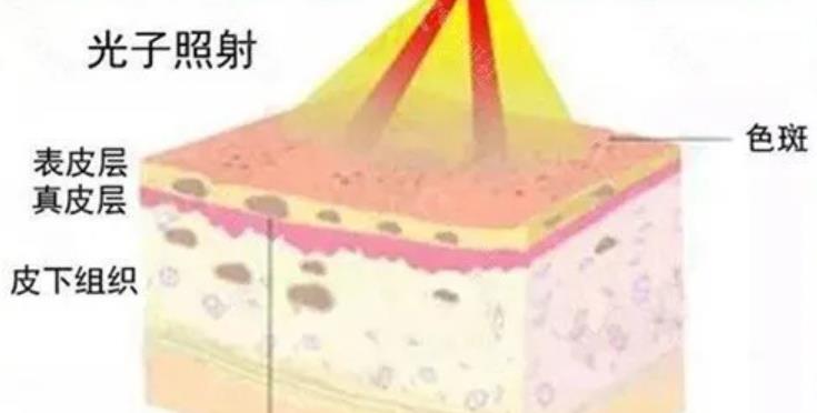 光子嫩肤