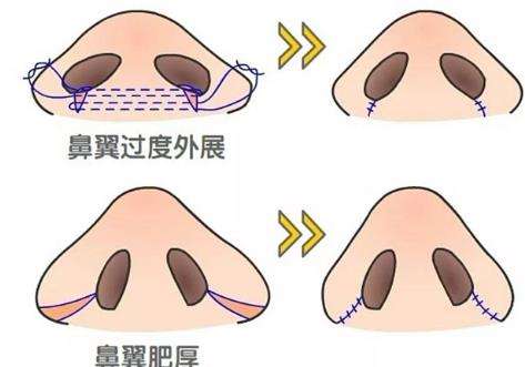 鼻翼缩小动漫图01.jpg