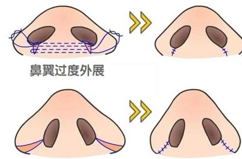 鼻翼缩小01.jpg