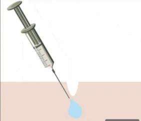 注射玻尿酸31.jpg
