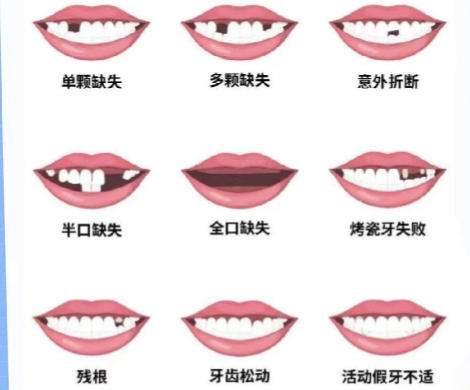 牙齿种植