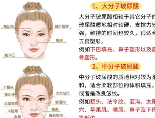 玻尿酸注射 玻尿酸注射