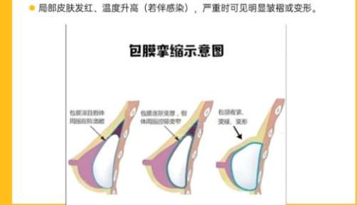 隆胸4.jpg