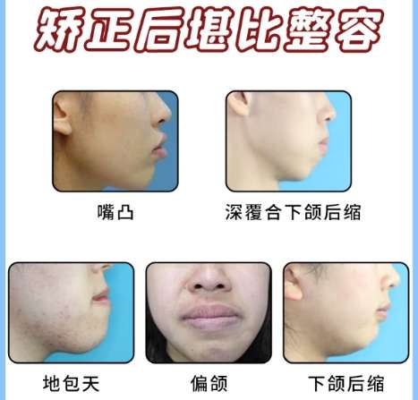 牙齿矫正