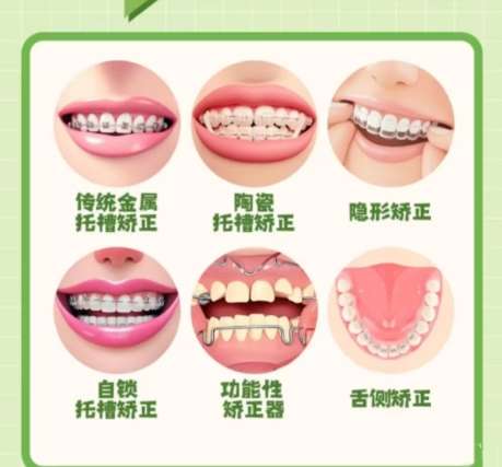 牙齿矫正
