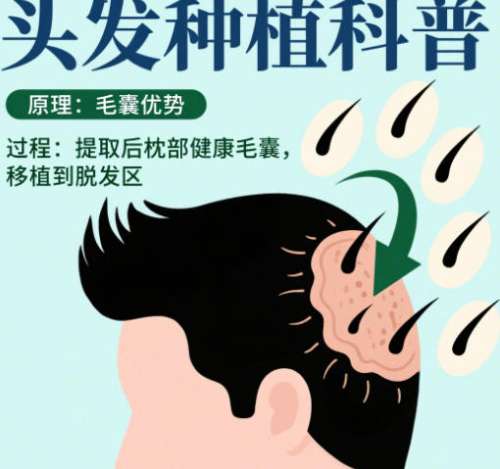 植发