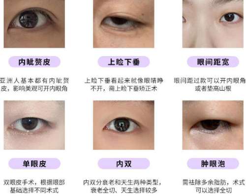 双眼皮修复dmm2.jpg