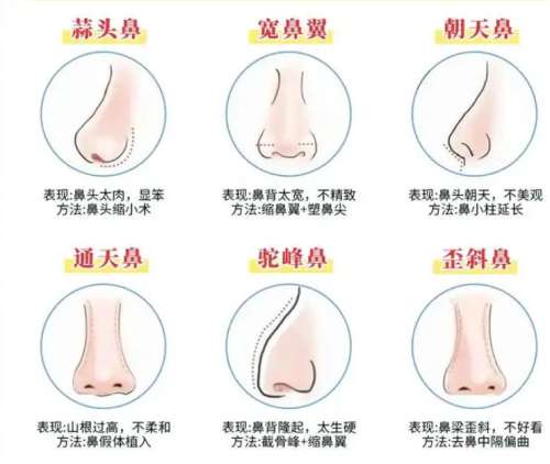 隆鼻