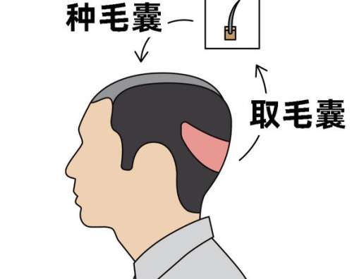 植发