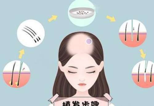 植发