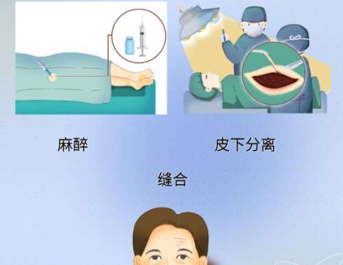拉皮 拉皮
