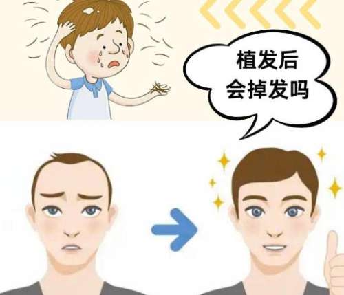 植发