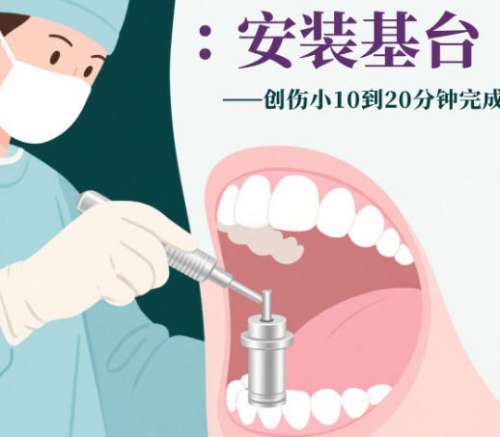 牙齿种植