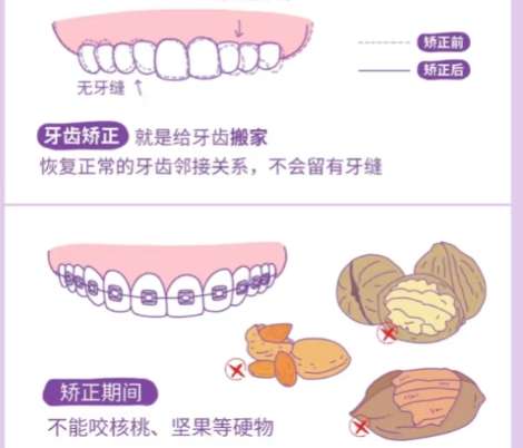 牙齿矫正