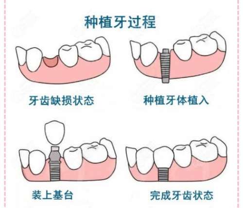牙齿种植