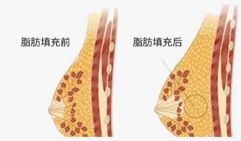 隆胸
