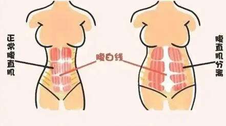 腹壁 腹壁