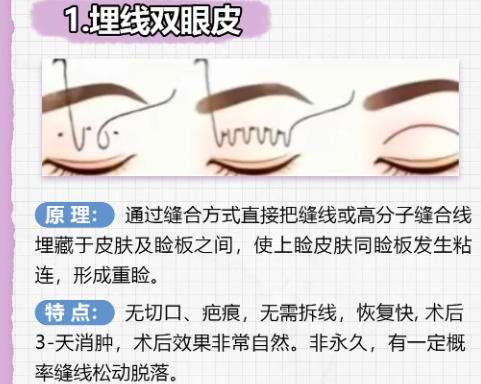 双眼皮2.jpg