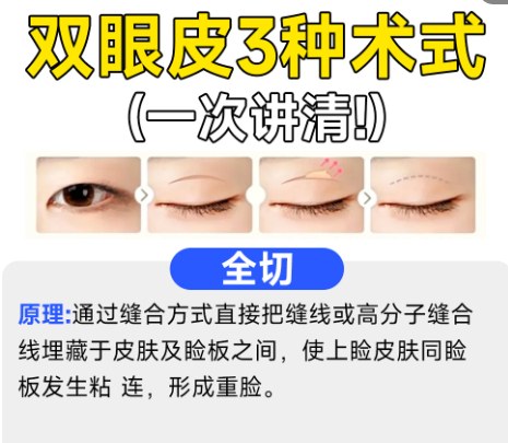 双眼皮5.png