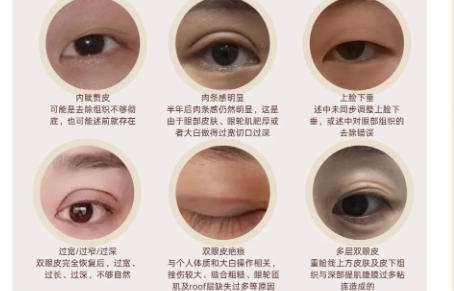 双眼皮修复3.jpg