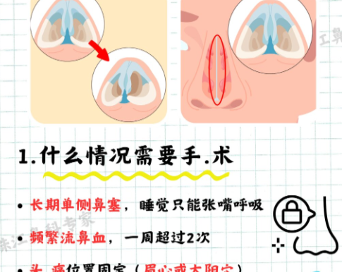 鼻修复7.bmp