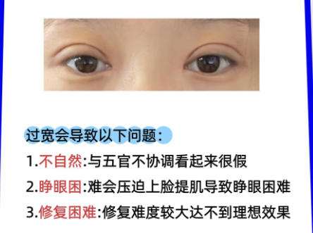 双眼皮修复1.jpg