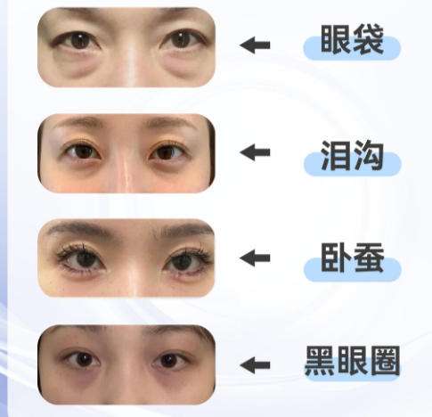 眼袋1.jpg