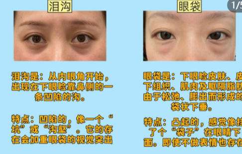 眼袋3.jpg