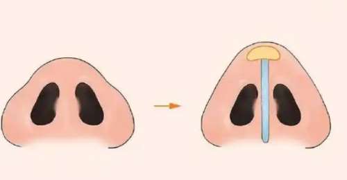 缩鼻翼