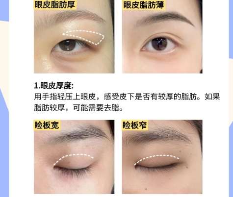 双眼皮