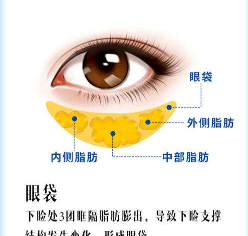 眼袋.jpg