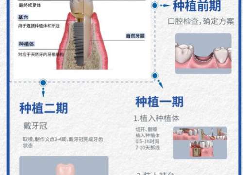 牙齿种植.jpg