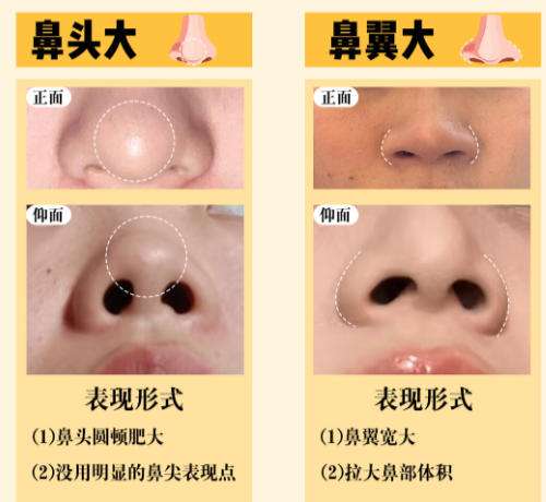 隆鼻1.jpg
